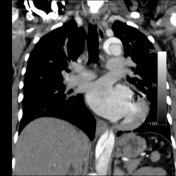File:Aortic dissection - Stanford type A (Radiopaedia 29247-29659 B 34).jpg
