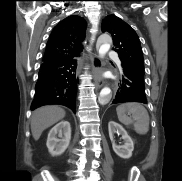 File:Aortic dissection with rupture into pericardium (Radiopaedia 12384-12647 B 30).jpg