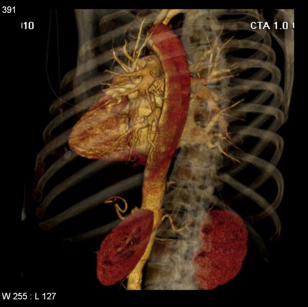File:Aortic dissection with rupture into pericardium (Radiopaedia 12384-12647 C+ arterial phase 23).jpg