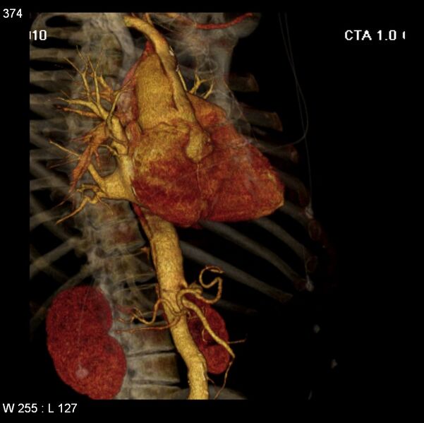 File:Aortic dissection with rupture into pericardium (Radiopaedia 12384-12647 C+ arterial phase 6).jpg