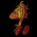 Aortic dissection with rupture into pericardium (Radiopaedia 12384-12647 D 25).jpg