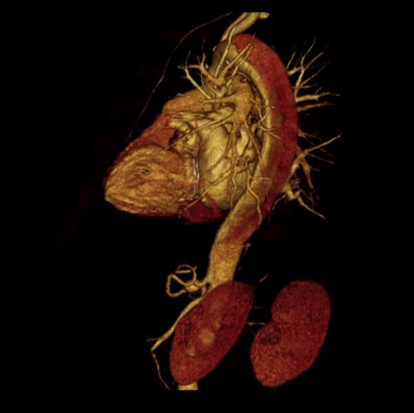 File:Aortic dissection with rupture into pericardium (Radiopaedia 12384-12647 D 25).jpg