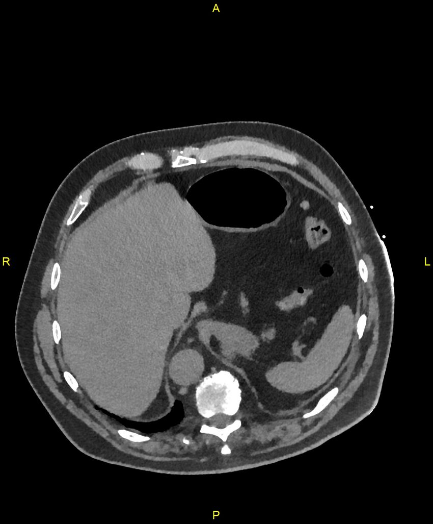Aortic rupture (Radiopaedia 88822-105594 Axial non-contrast 215).jpg