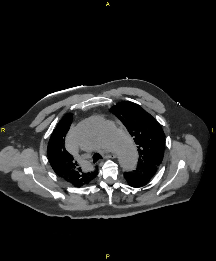 Aortic rupture (Radiopaedia 88822-105594 Axial non-contrast 56).jpg
