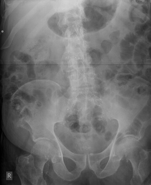 File:Aortic stent (Radiopaedia 33202).jpg