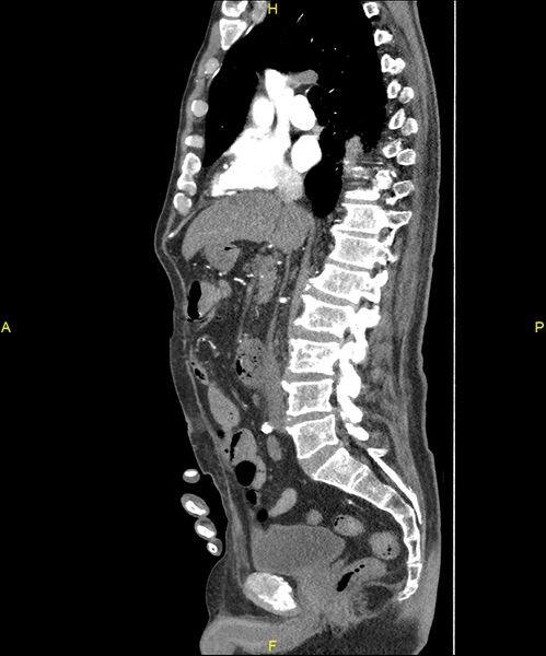 File:Aortoenteric fistula (Radiopaedia 84308-99603 C 160).jpg