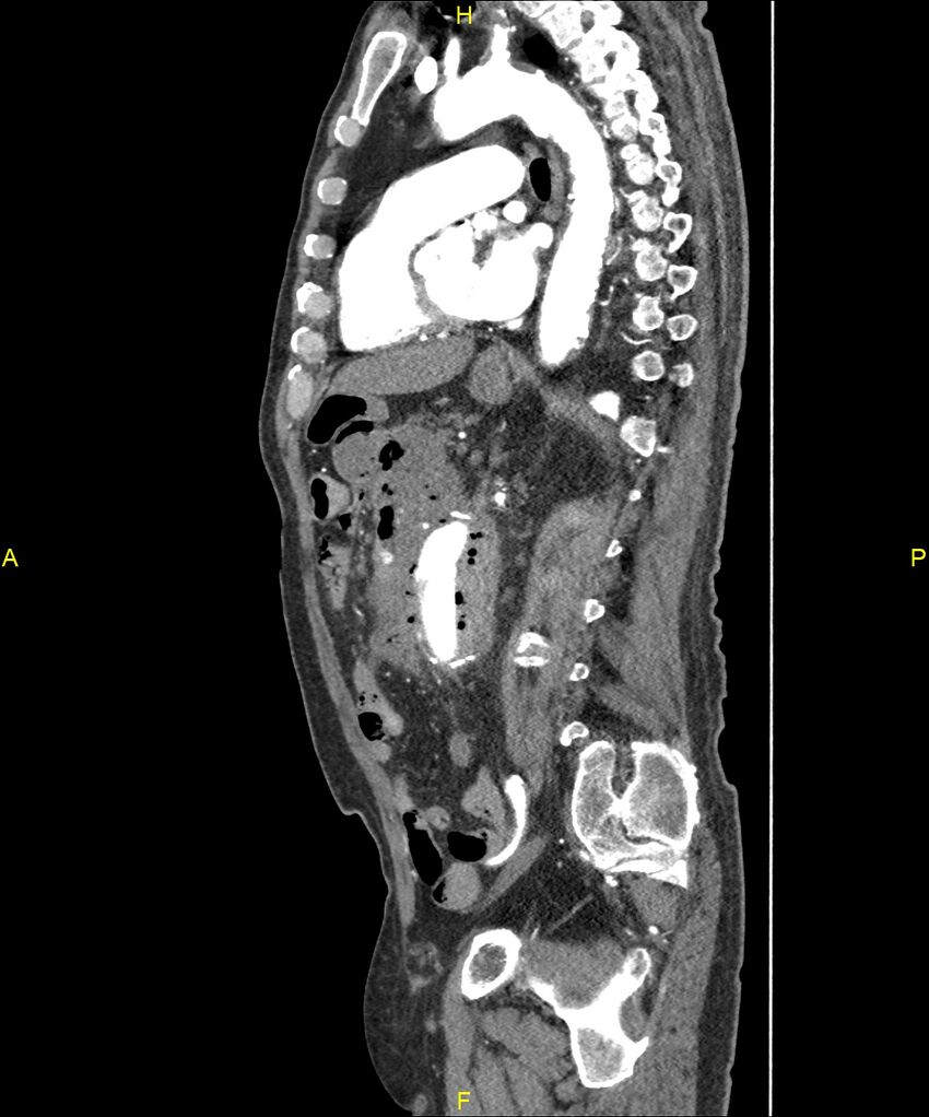 Aortoenteric fistula (Radiopaedia 84308-99603 C 206).jpg