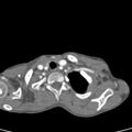 Aortopulmonary window, interrupted aortic arch and large PDA giving the descending aorta (Radiopaedia 35573-37074 B 6).jpg