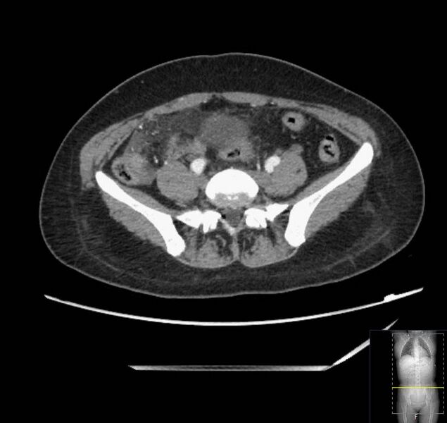 File:Appendicitis (CT angiogram) (Radiopaedia 154713-127660 Axial 21).jpg