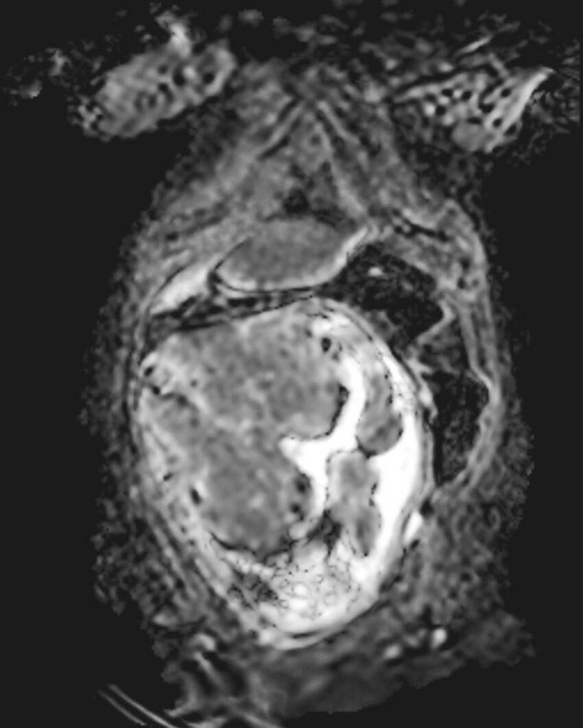 Appendicitis in gravida (MRI) (Radiopaedia 89433-106395 Coronal ADC 14).jpg