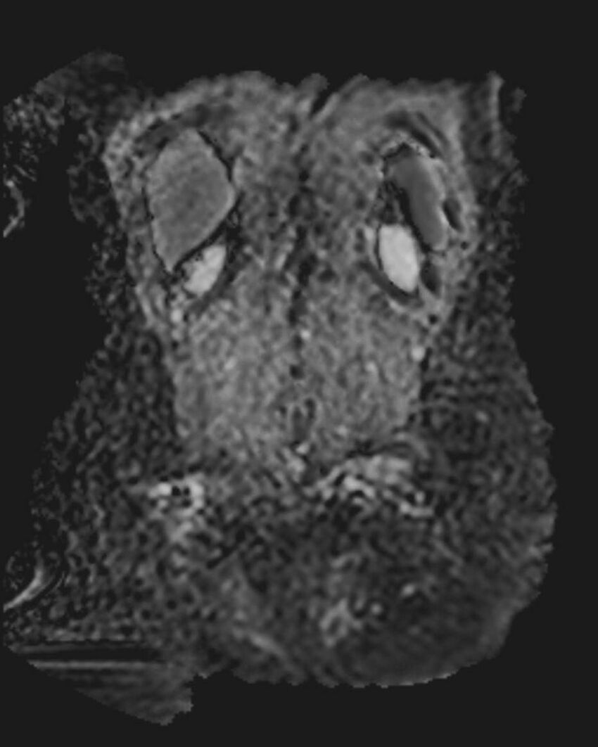 Appendicitis in gravida (MRI) (Radiopaedia 89433-106395 Coronal ADC 49).jpg