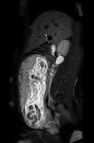 File:Appendicitis in gravida (MRI) (Radiopaedia 89433-106395 Sagittal T2 SPAIR 38).jpg