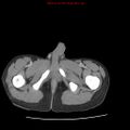 Appendicitis with phlegmon (Radiopaedia 9358-10046 A 75).jpg