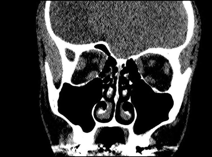 Arachnoid cyst- extremely large (Radiopaedia 68741-78450 Coronal bone window 47).jpg