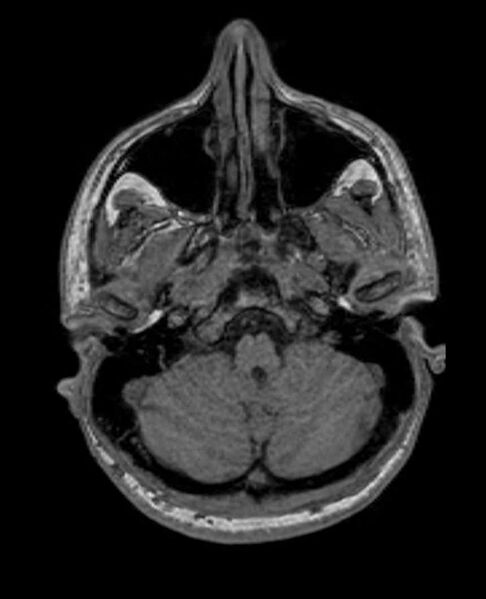 File:Arachnoid cyst- extremely large (Radiopaedia 68741-78451 Axial T1 15).jpg