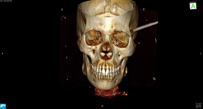 File:Arrow injury to the head (Radiopaedia 75266-86388 3D vertical 4).jpg