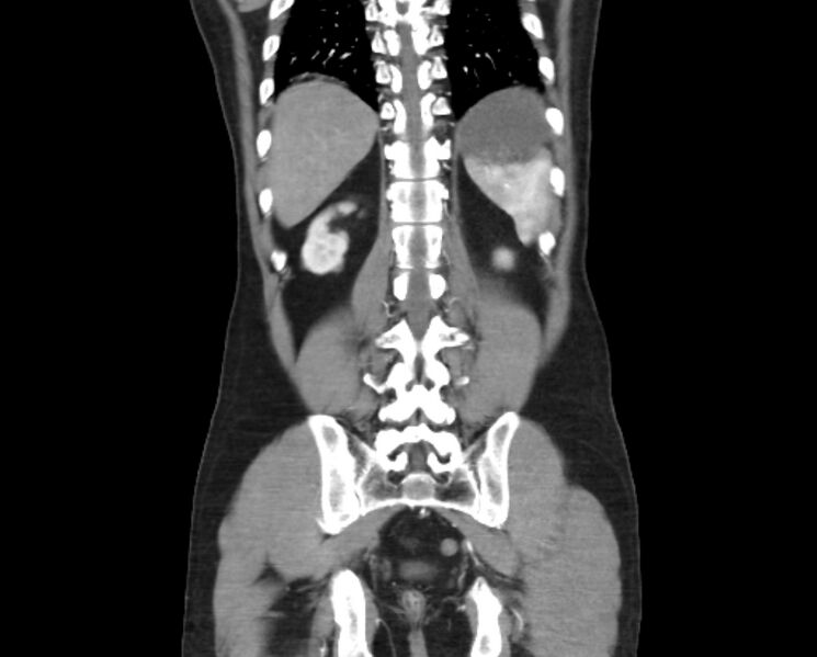 File:Arterial occlusive mesenteric ischemia (Radiopaedia 84641-100060 B 44).jpg