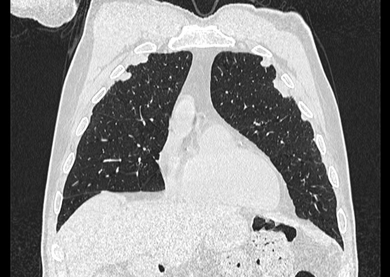 File:Asbestos pleural placques (Radiopaedia 57905-64872 Coronal lung window 66).jpg