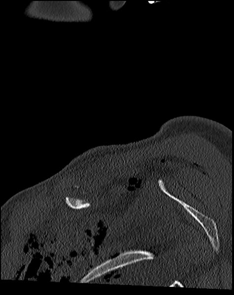 File:Atlanto-occipital dissociation - Traynelis type 1 (Radiopaedia 87570-103948 Sagittal bone window 3).jpg