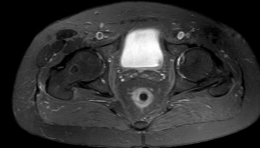 Atypical lipomatous tumor - thigh (Radiopaedia 68975-78734 Axial PD fat sat 92).jpg