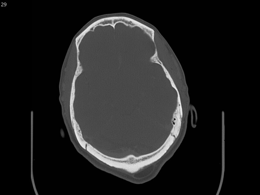 Atypical meningioma - intraosseous (Radiopaedia 64915-73867 Axial C+ bone window 29).jpg