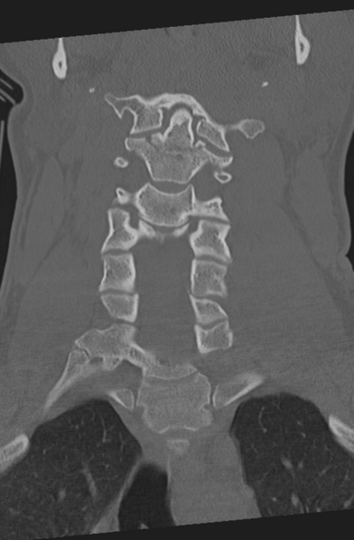 File:Axis peg fracture (type 3) and atlas lateral mass (type 4) fracture (Radiopaedia 37474-39324 Coronal bone window 19).png