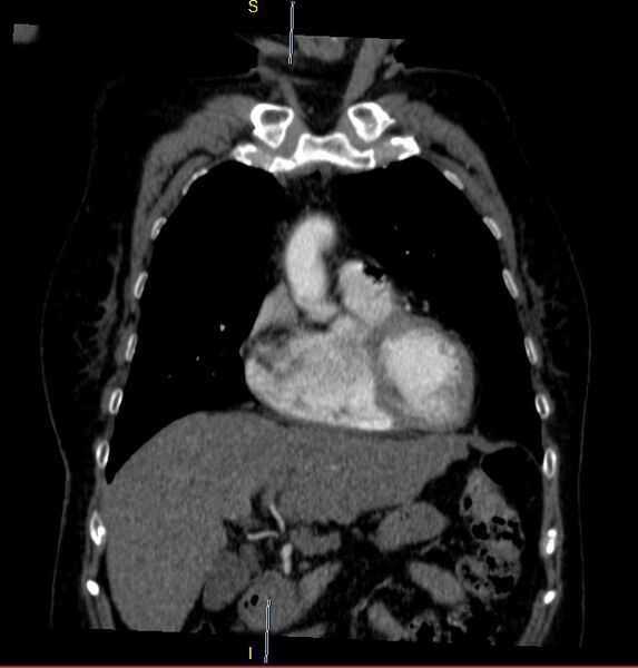 File:Azygos vein aneurysm (Radiopaedia 77824-90130 C 9).JPG