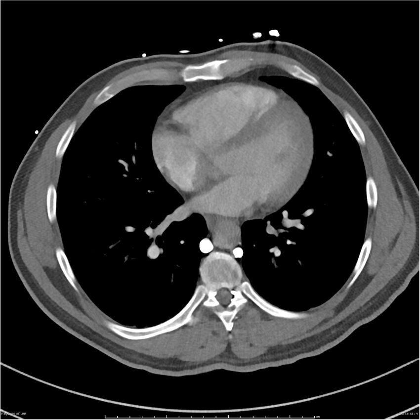 Azygos venous system anatomy (CT pulmonary angiography) (Radiopaedia 25928-26077 Axial C+ CTPA 56).jpg