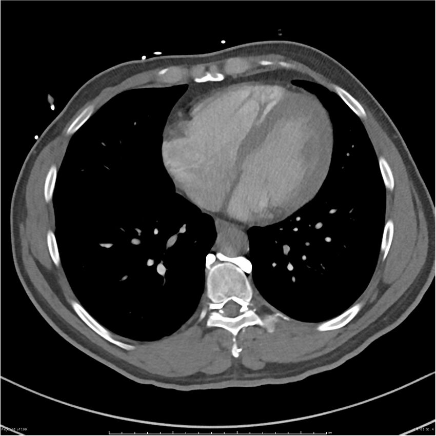 Azygos venous system anatomy (CT pulmonary angiography) (Radiopaedia 25928-26077 Axial C+ CTPA 61).jpg