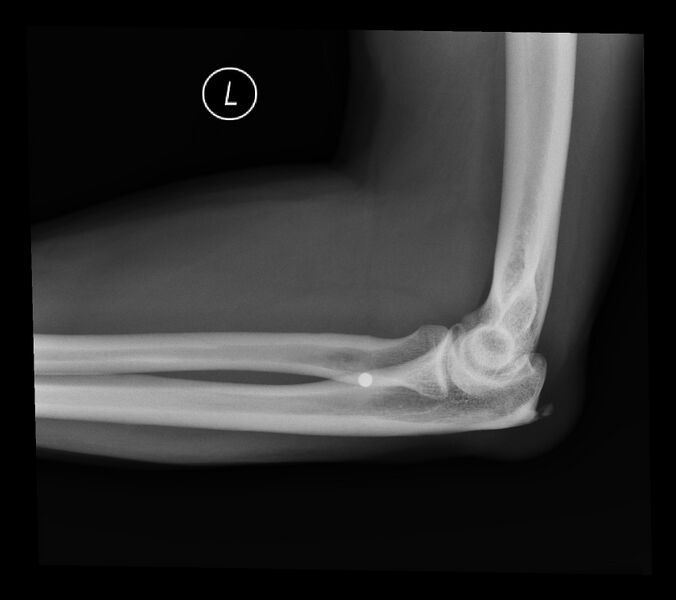 File:BB (ball bearing) bullet within the soft tissues of the forearm (Radiopaedia 44382-48017 Lateral 1).jpg