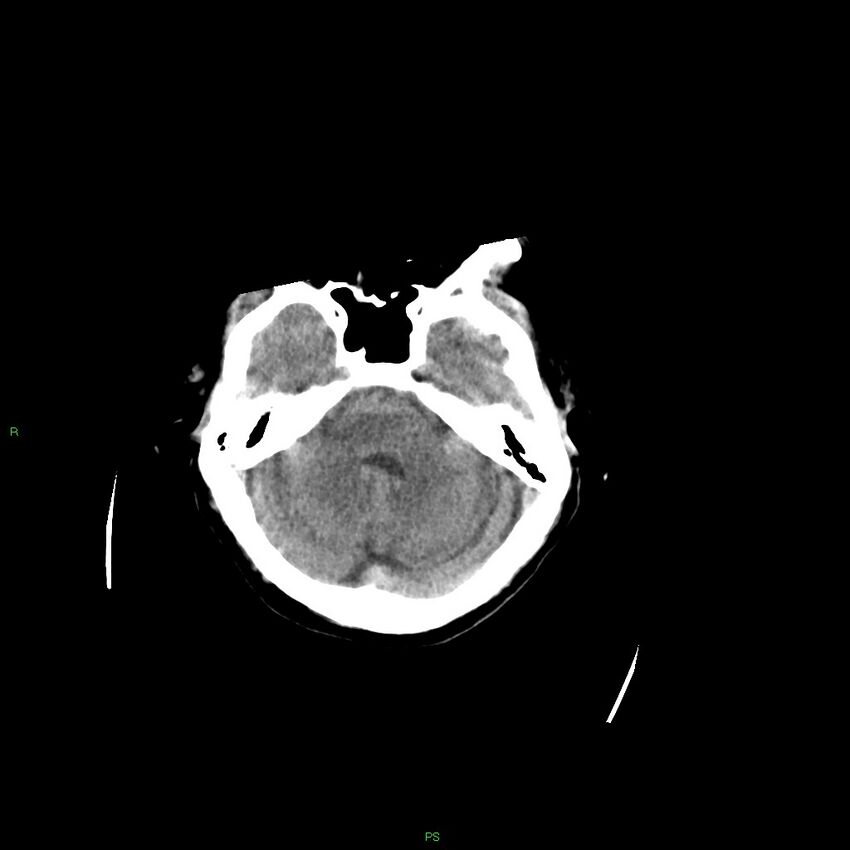 Basal ganglia hemorrhage (Radiopaedia 58349-65472 Axial non-contrast 43).jpg