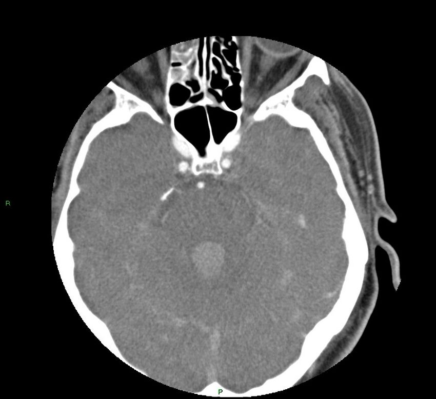 Basal ganglia hemorrhage (Radiopaedia 58763-65985 D 62).jpg