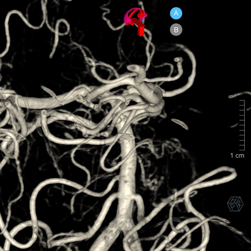 Basilar artery perforator aneurysm (Radiopaedia 82455-97734 3D view left VA 151).jpg