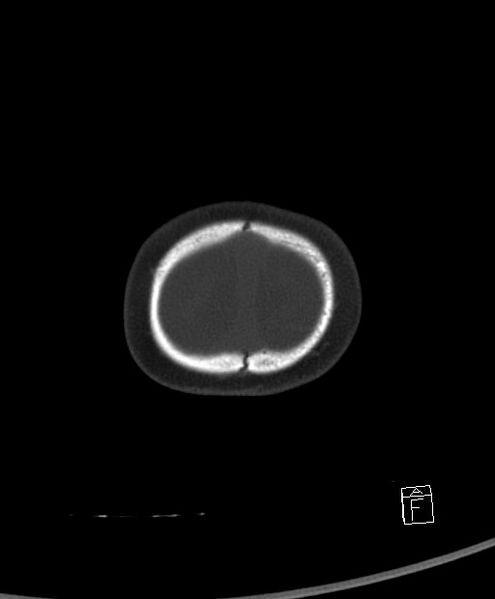 File:Benign enlargement of subarachnoid spaces in infancy (BESS) (Radiopaedia 87459-103795 Axial bone window 3).jpg