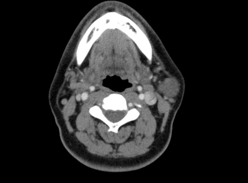File:Benign mixed salivary tumor of the parotid gland (Radiopaedia 35261-36792 A 26).jpg