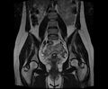 Bicornuate bicollis uterus (Radiopaedia 61626-69616 Coronal T2 18).jpg