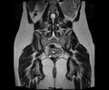 Bicornuate bicollis uterus (Radiopaedia 61626-69616 Coronal T2 24).jpg