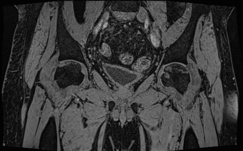 File:Bilateral avascular necrosis of femoral head (Radiopaedia 77116-89078 Coronal T2 we 47).jpg