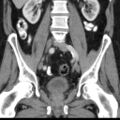 Bilateral direct inguinal herniae (Radiopaedia 17016-16719 A 23).jpg