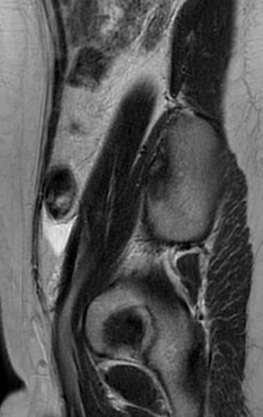 File:Bilateral ovarian fibrothecomas - adolescent (Radiopaedia 86604-102707 Sagittal T2 28).jpg