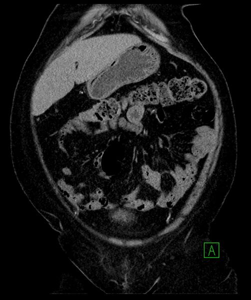 File:Bilateral sporadic synchronous clear cell renal cell carcinoma (Radiopaedia 85035-100575 D 31).jpg