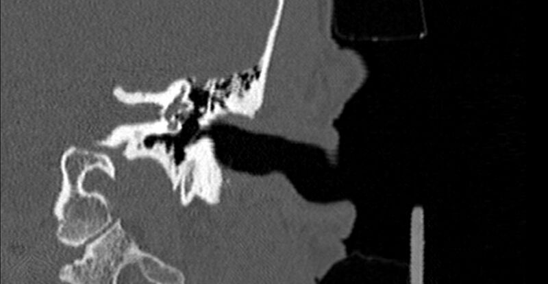 File:Bilateral temporal bone fractures (Radiopaedia 29482-29970 B 36).jpg