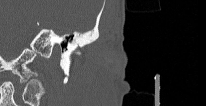 File:Bilateral temporal bone fractures (Radiopaedia 29482-29970 B 7).jpg