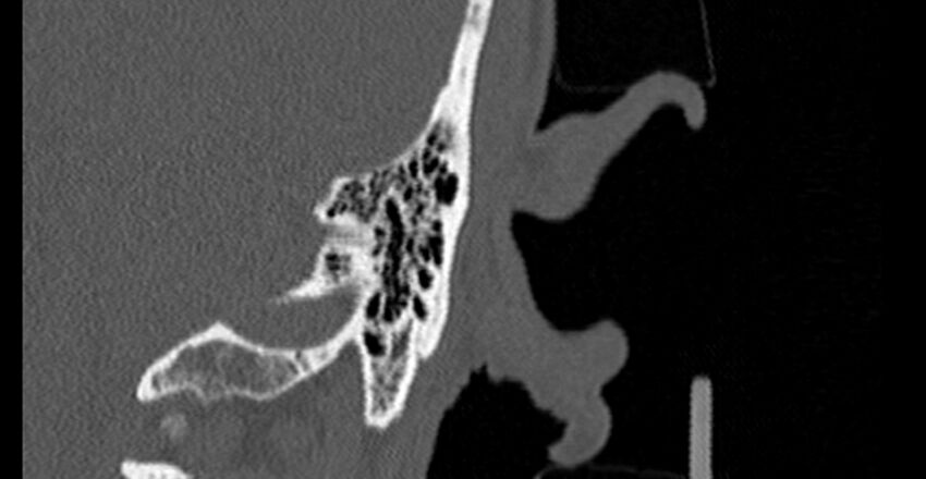 Bilateral temporal bone fractures (Radiopaedia 29482-29970 B 91).jpg