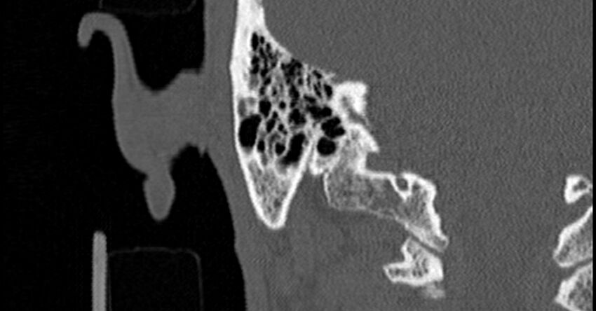 Bilateral temporal bone fractures (Radiopaedia 29482-29970 Coronal non-contrast 151).jpg