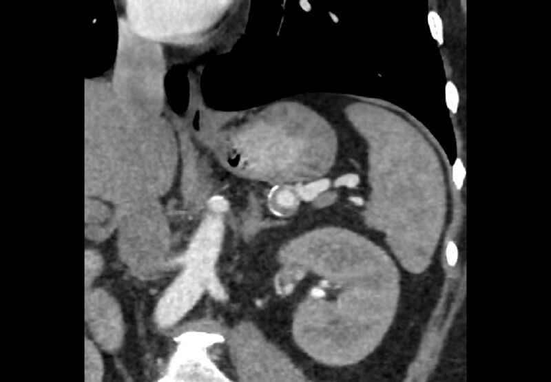 File:Bilateral urolithiasis with incidentally detected splenic artery aneurysm and left inferior vena cava (Radiopaedia 44467-48127 Ob. Cor. C+ Art. 12).jpg