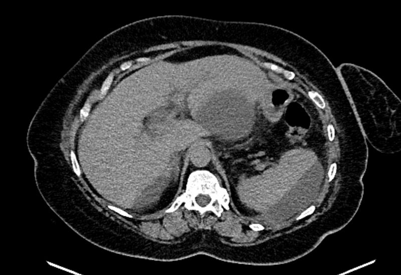 File:Biliary pancreatitis (Radiopaedia 72289-82823 Axial non-contrast 77).jpg