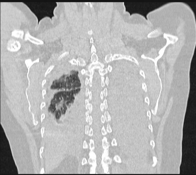 File:Boerhaave syndrome (Radiopaedia 45644-49799 Coronal lung window 57).jpg