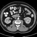 Bosniak cyst - type IV (Radiopaedia 23525-23627 renal cortical phase 31).jpg