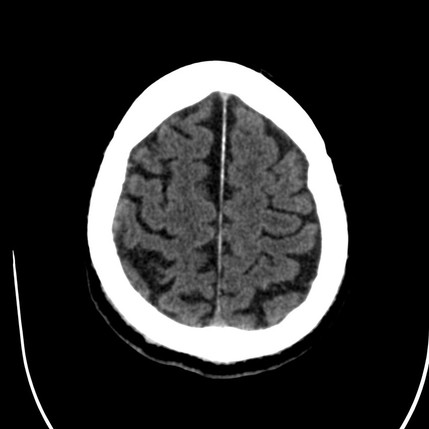 Brain Pantopaque remnants (Radiopaedia 78403-91048 Axial non-contrast 74).jpg